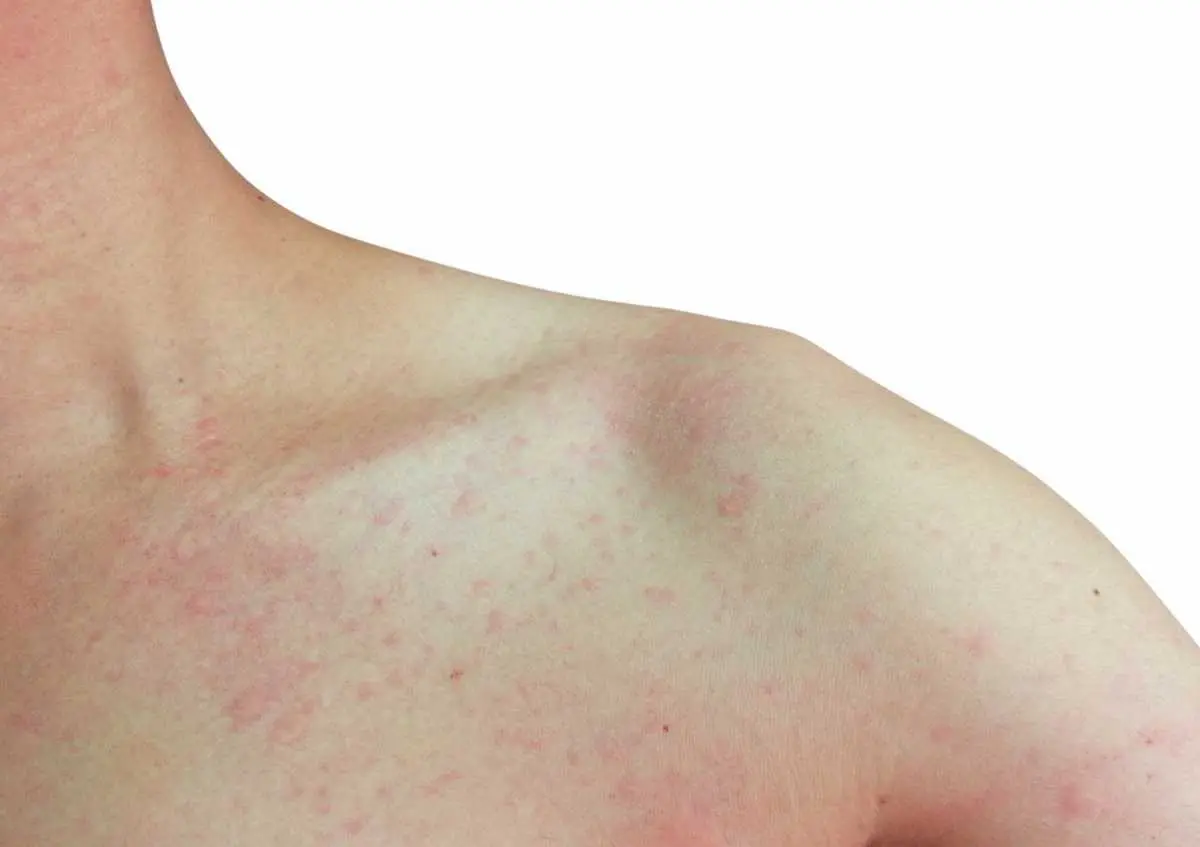 Mastositoz Nedir Belirtileri Nelerdir