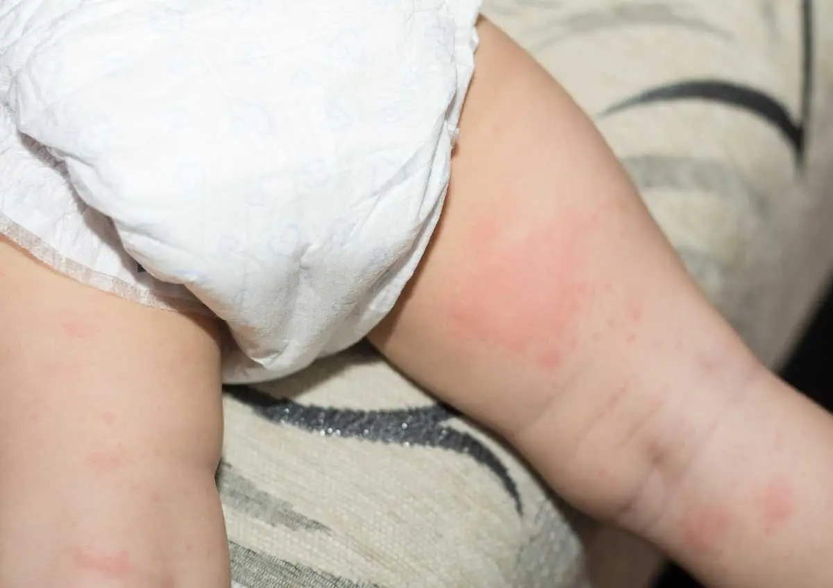 Bebeklerde ve Çocuklarda Pişik