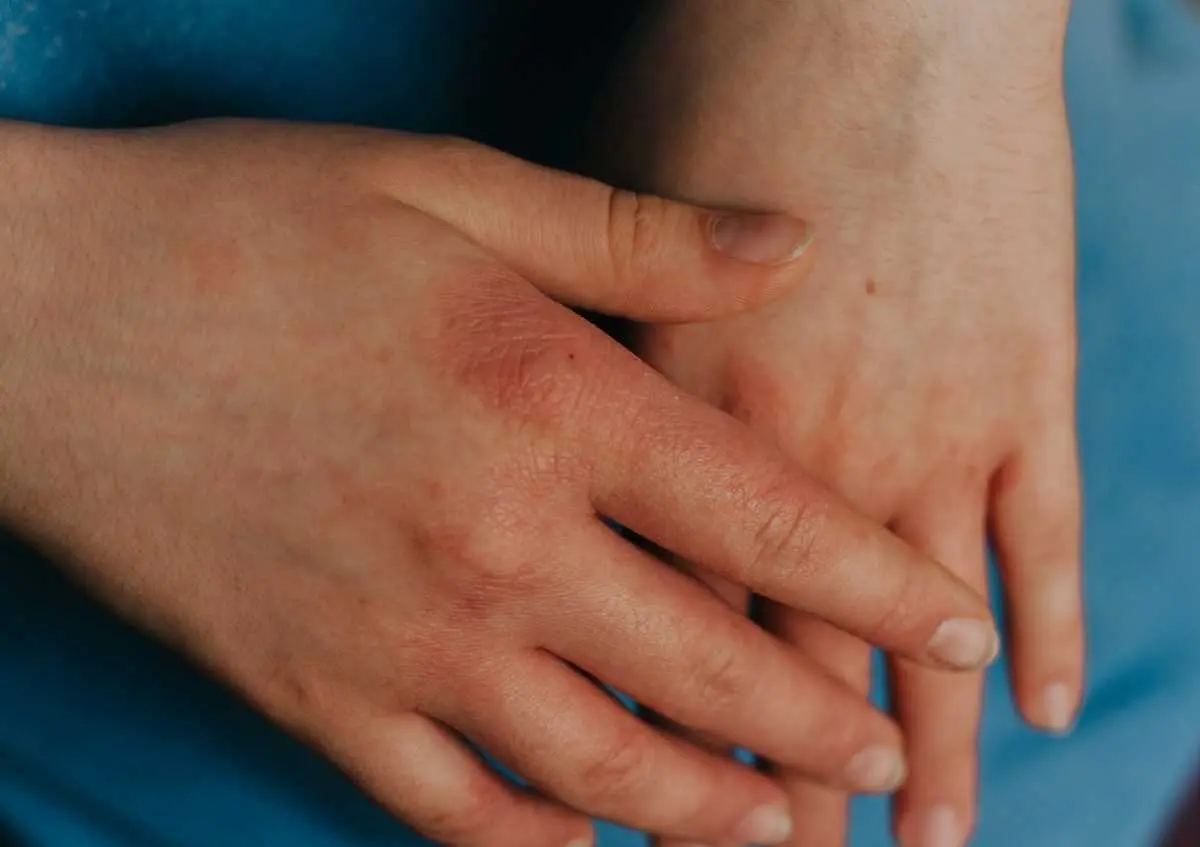 Egzama Bulaşıcı Mıdır