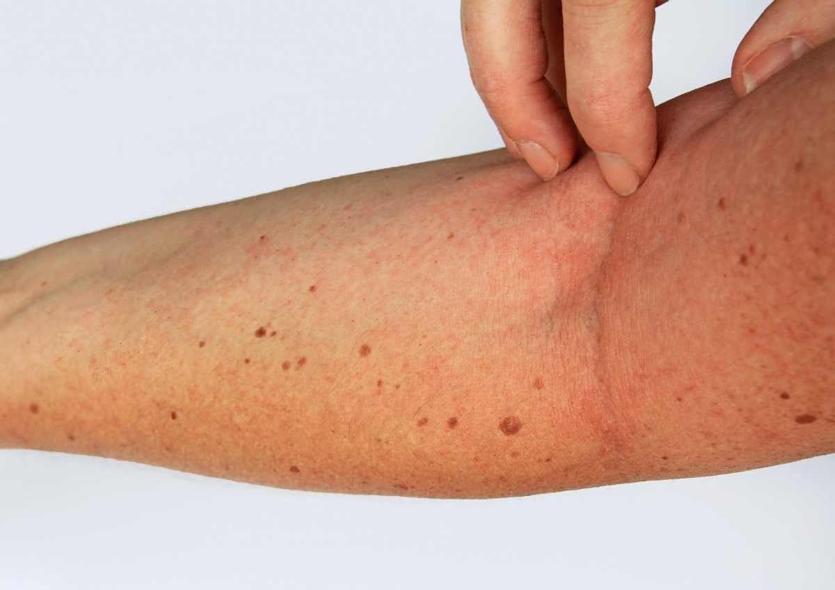 Yetişkinlerde Temas Alerjisi ( Alerjik Kontakt Dermatit) Nedir