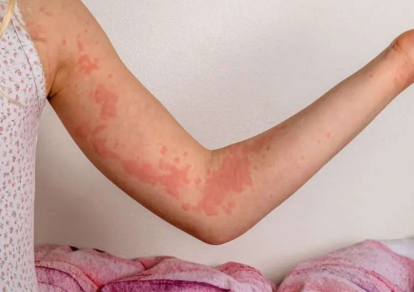 Ürtiker (Kurdeşen) Nedir Ürtiker Nasıl Tedavi Edilir