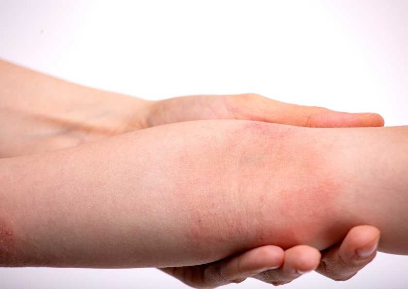 Atopik Dermatit İçin Alerji Testi Gerekli mi