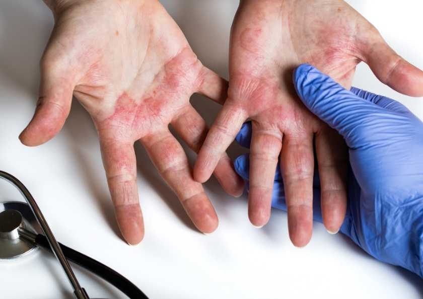 Atopik Dermatit Tedavisinde Neler Var Kortizon Nemlendirici ve Daha Fazlası