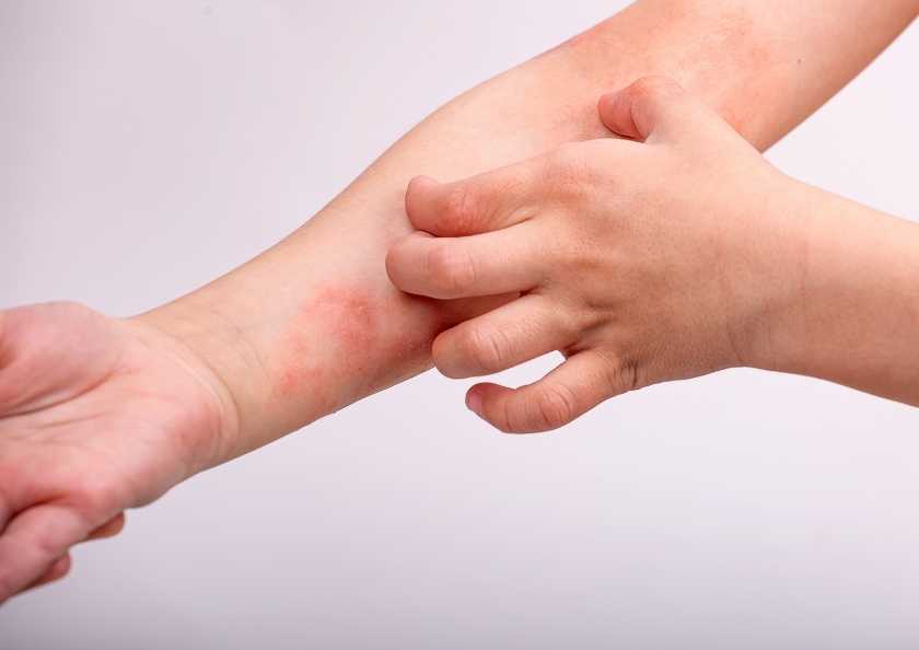 Çocukluk Çağında Atopik Egzama