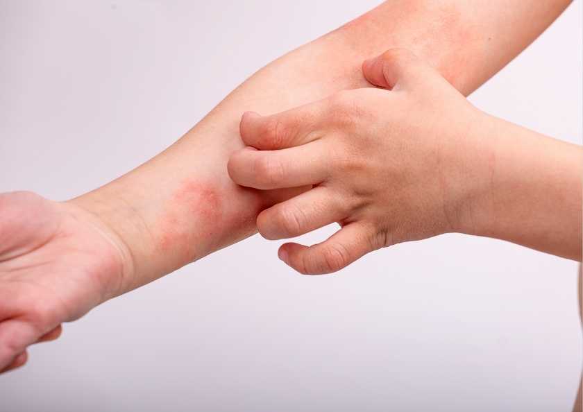 Kronik Kaşıntı ve Kızarıklık Atopik Dermatit Habercisi Olabilir mi