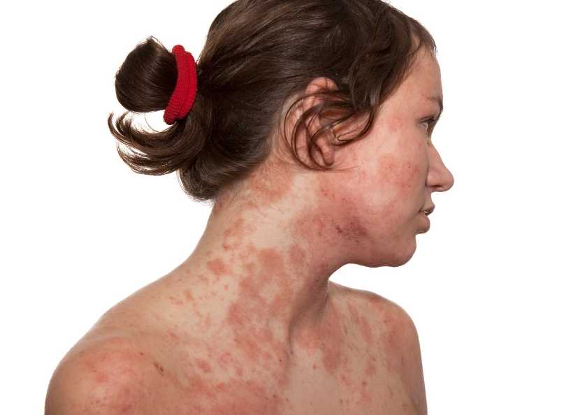 Yetişkinlerde Atopik Dermatit Geçici mi, Kronik mi