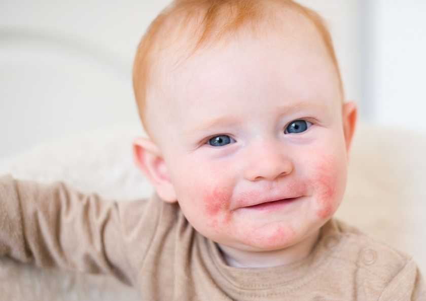 Bebeklerde Atopik Dermatit: İlk Belirtiler Ne Zaman Ortaya Çıkar?