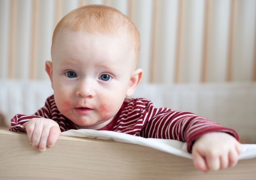 Alerjik Yürüyüş (Atopic March)